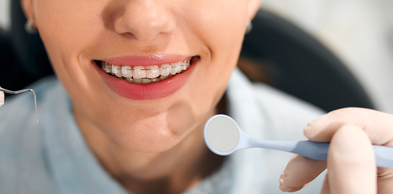 orthodontics-tijuana-woman-smiling-with-white-braces