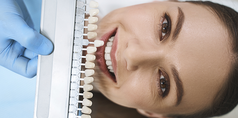 Tijuana-dental-veneers