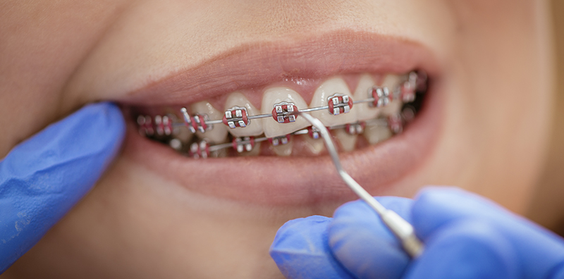 dental-braces