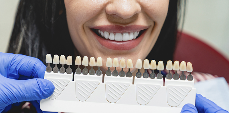 dental-veneers-tijuana