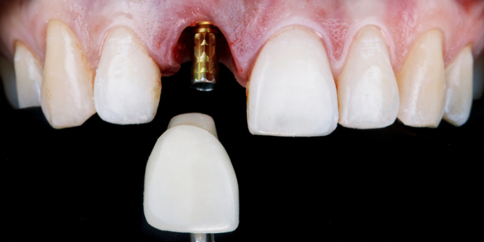 Implantes dentales en Tijuana