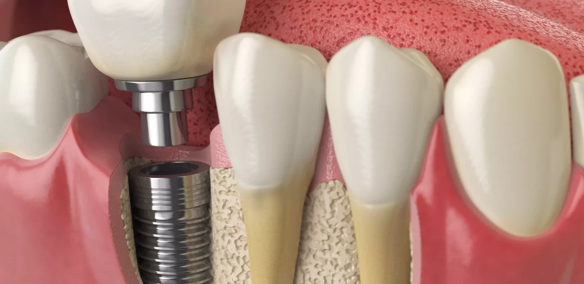 dental-implants-healing-process