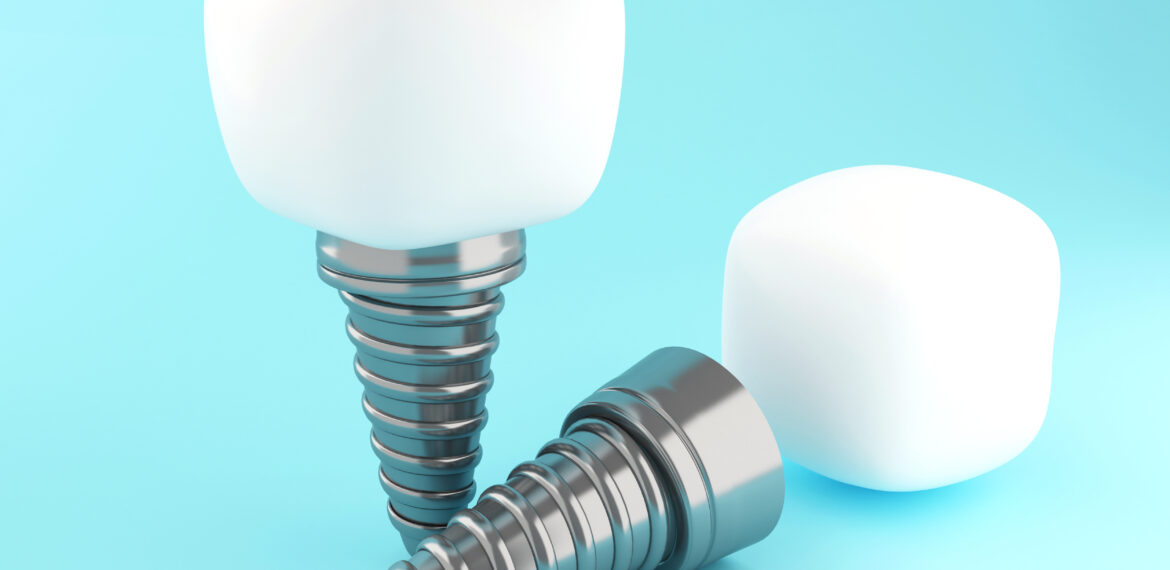 Dental Implants in Tijuana