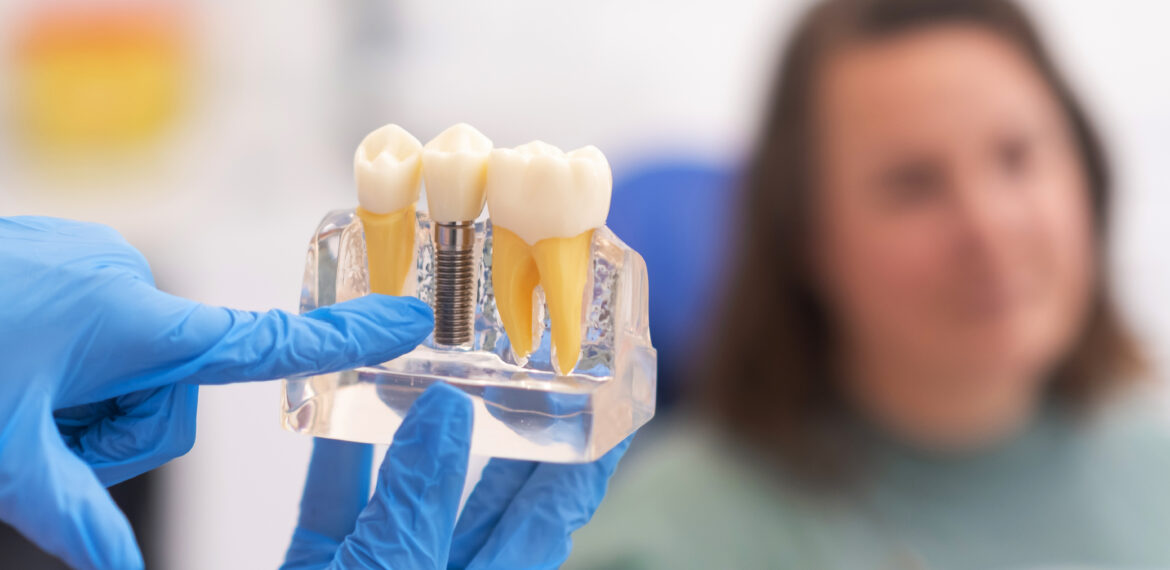 Implantes dentales en Tijuana