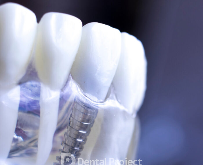 Dental Implants in Tijuana