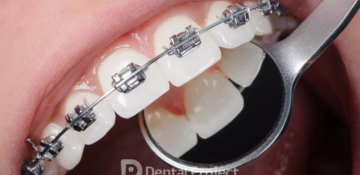 Orthodontics Treatment in Tijuana