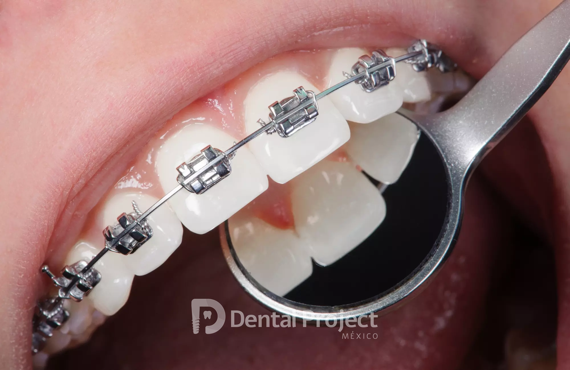 Orthodontics Treatment in Tijuana