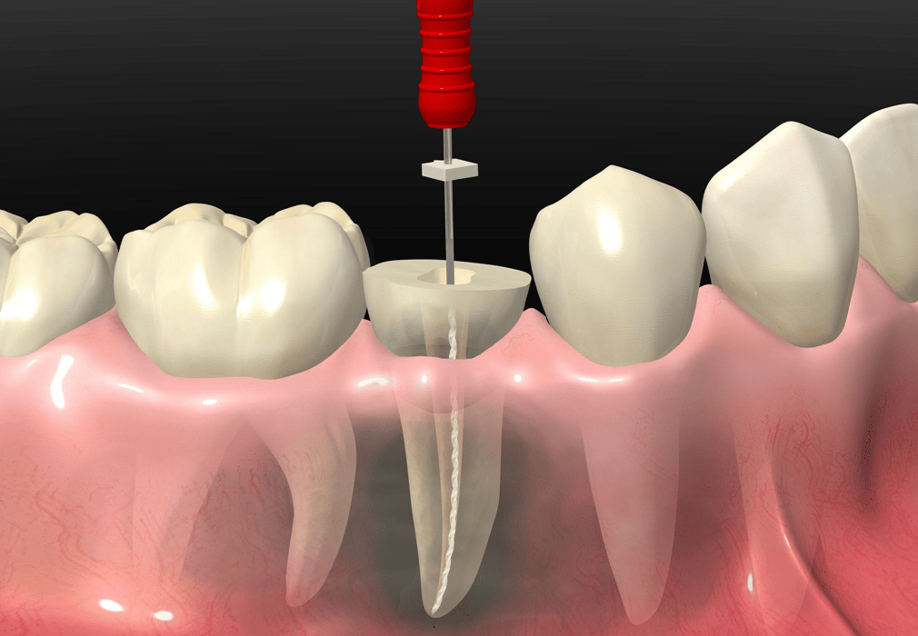 Tratamiento de endodoncia