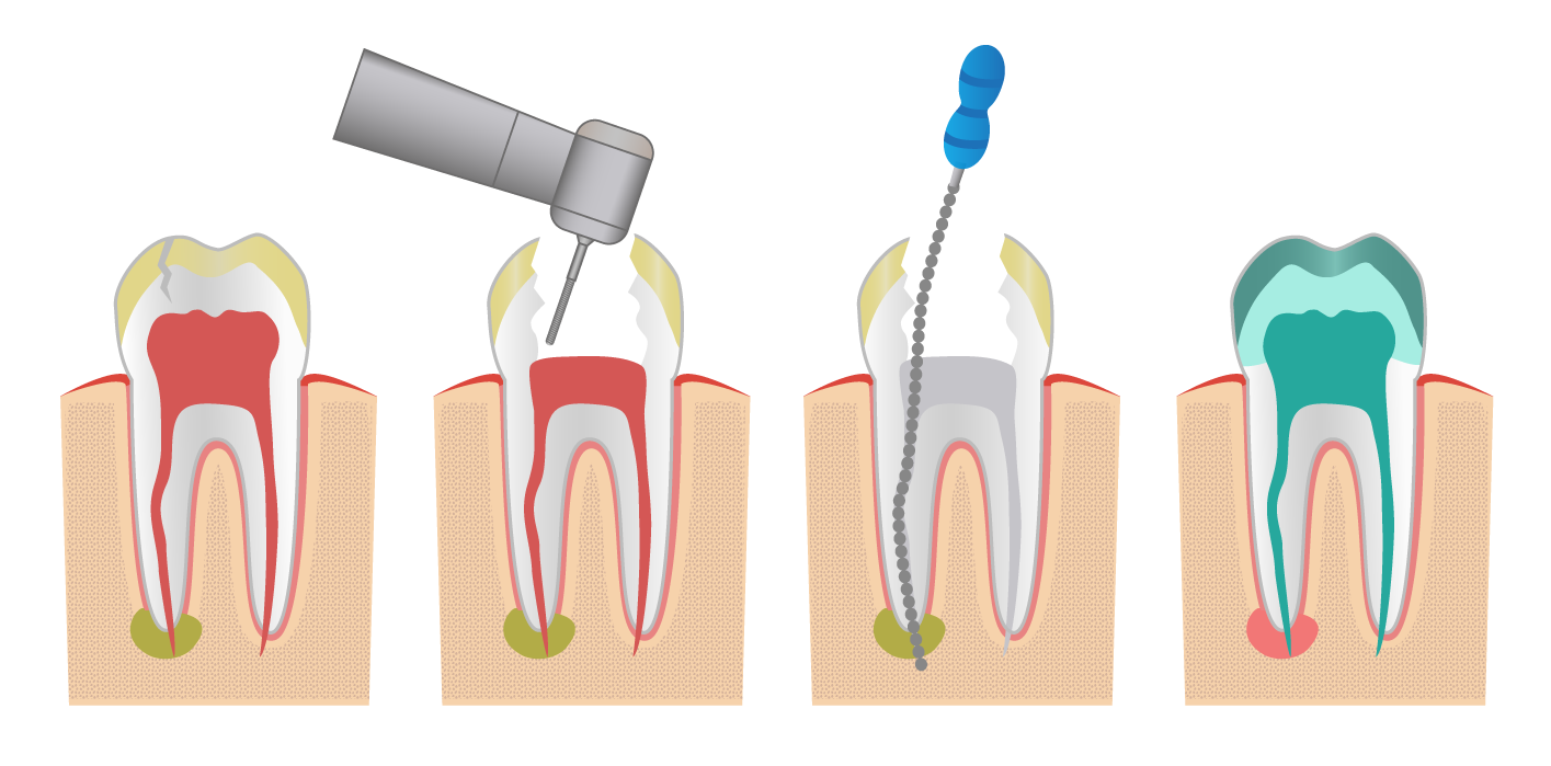 Explicación gráfica de un tratamiento de endodoncia