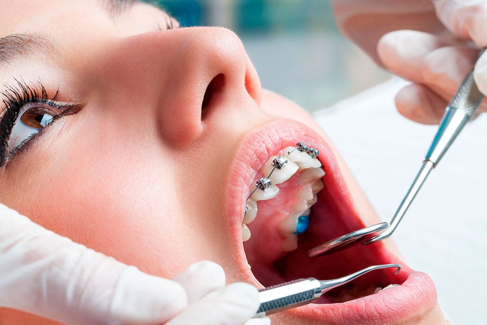 Orthodontics in Tijuana treatment