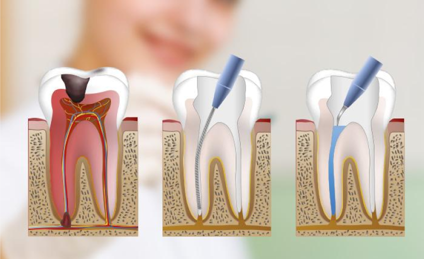 endodoncia-tijuana