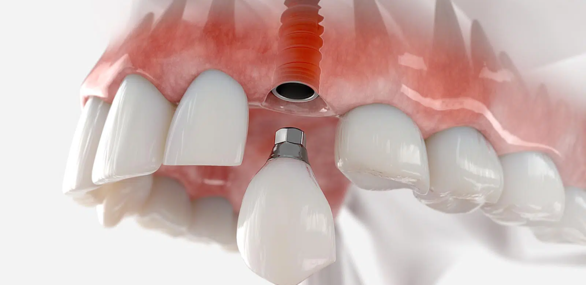 Broken-tooth-implant