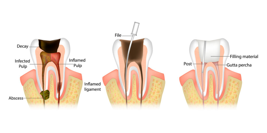 Root canal