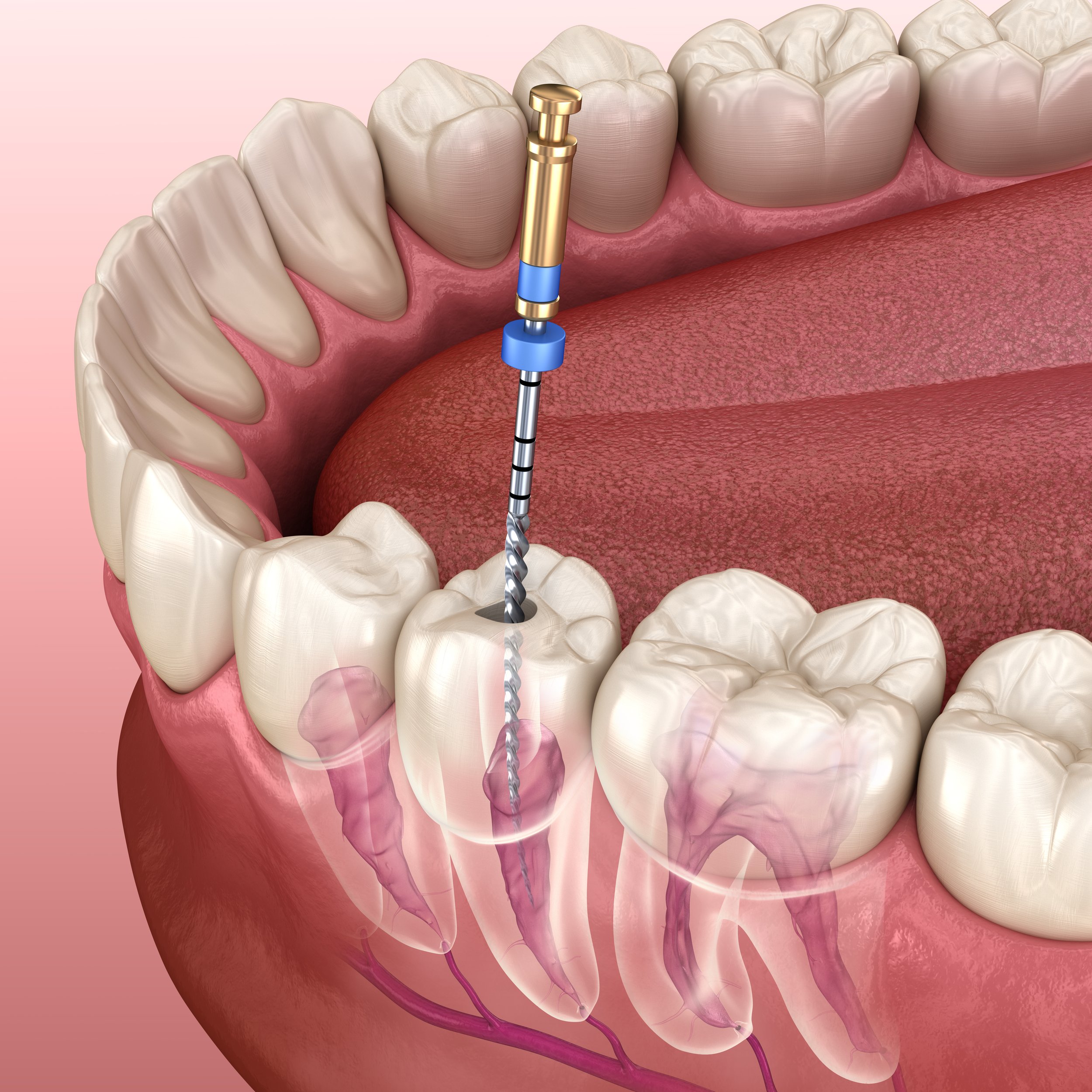 Root canal