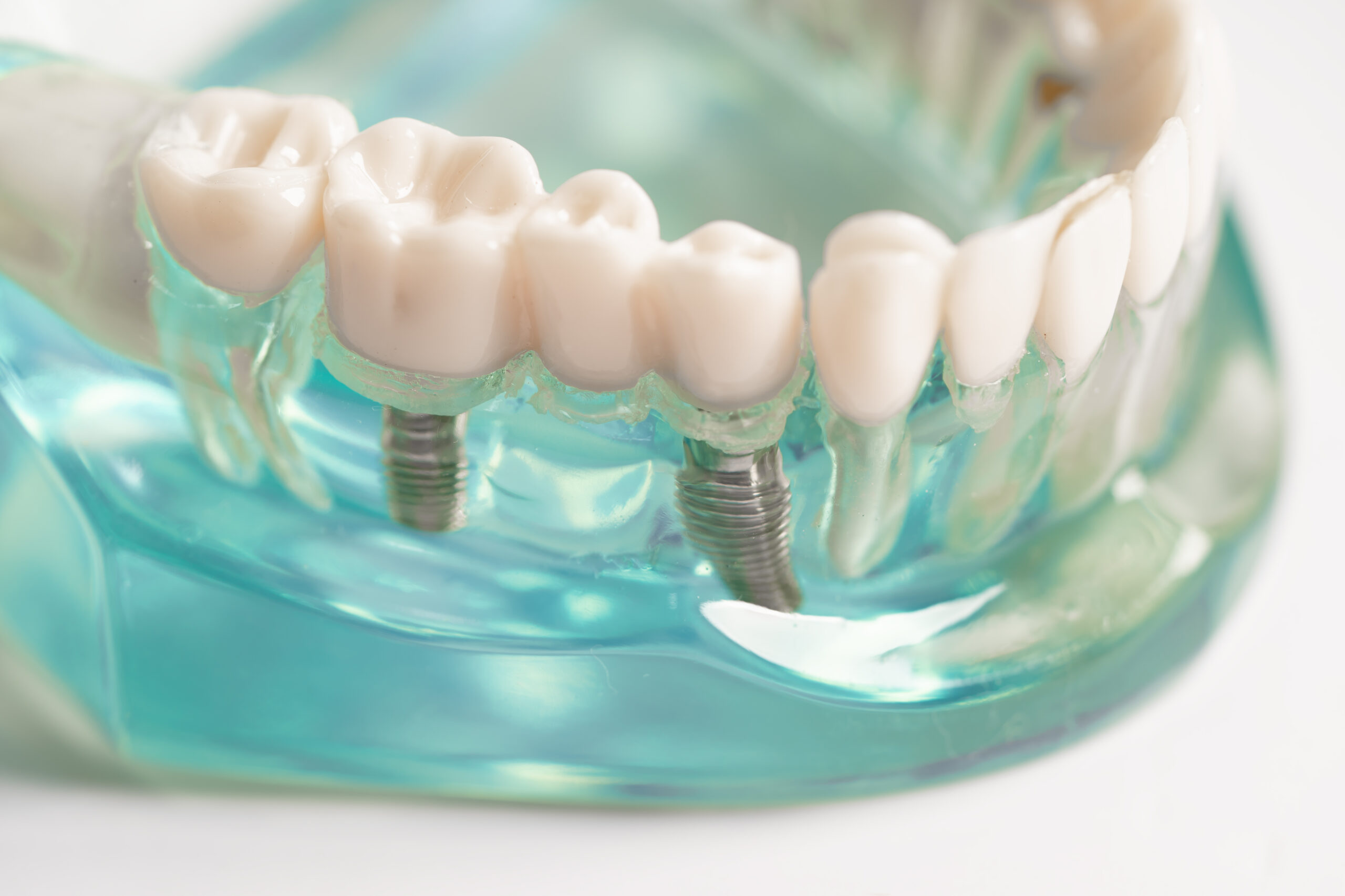 Dental-implants-Tijuana