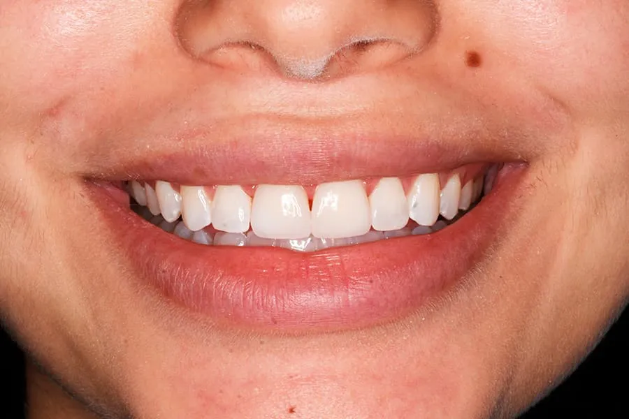 teeth-whitening-after