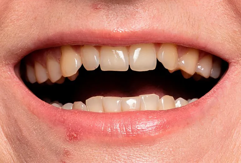 teeth-whitening-before