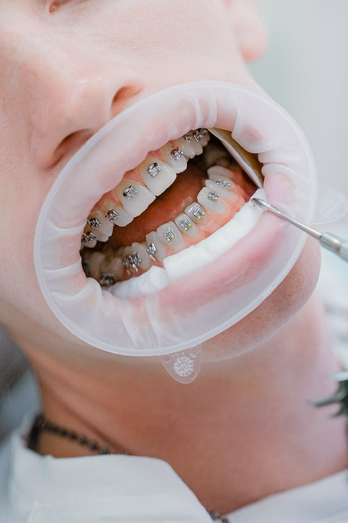 orthodontics treatment