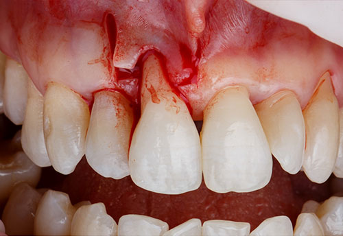 periodoncia cirugia osea