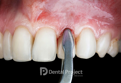 tratamiento cirugia oral