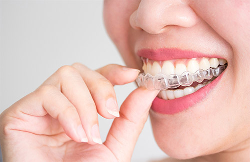 tratamiento ortodoncia invisalign