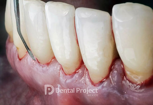 tratamiento periodoncia