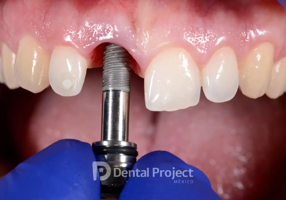 dental implant