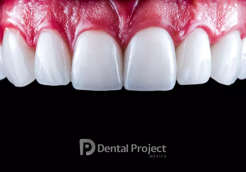 dental-veneers