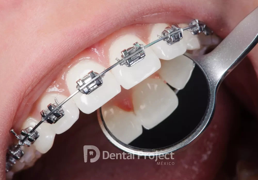 Orthodontics Treatment in Tijuana