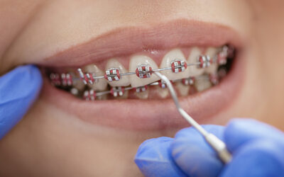 What is the best age to get braces?