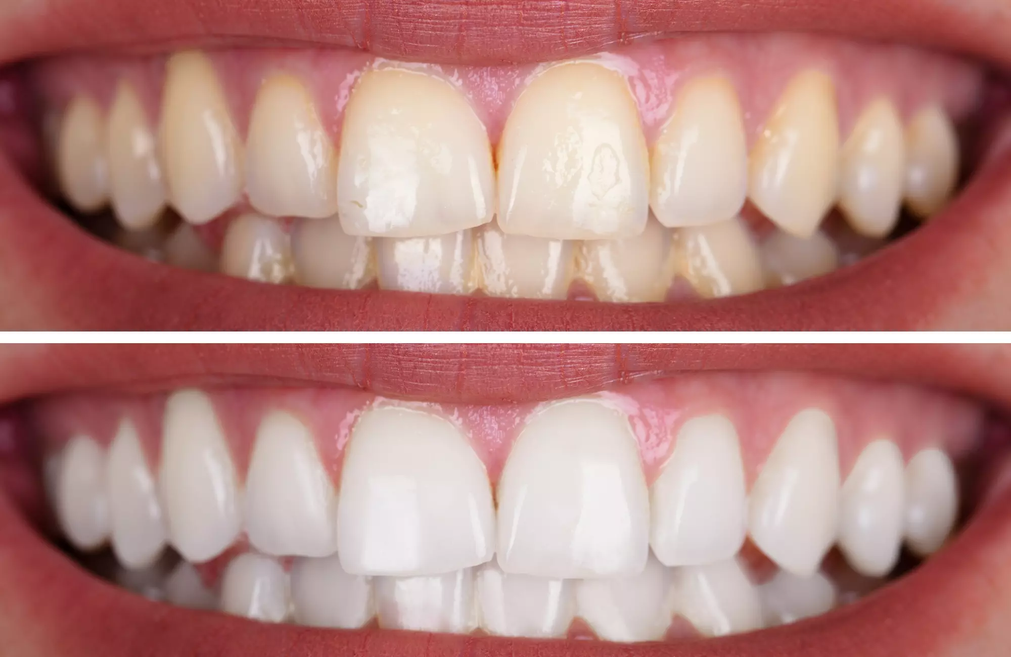 Dental whitening