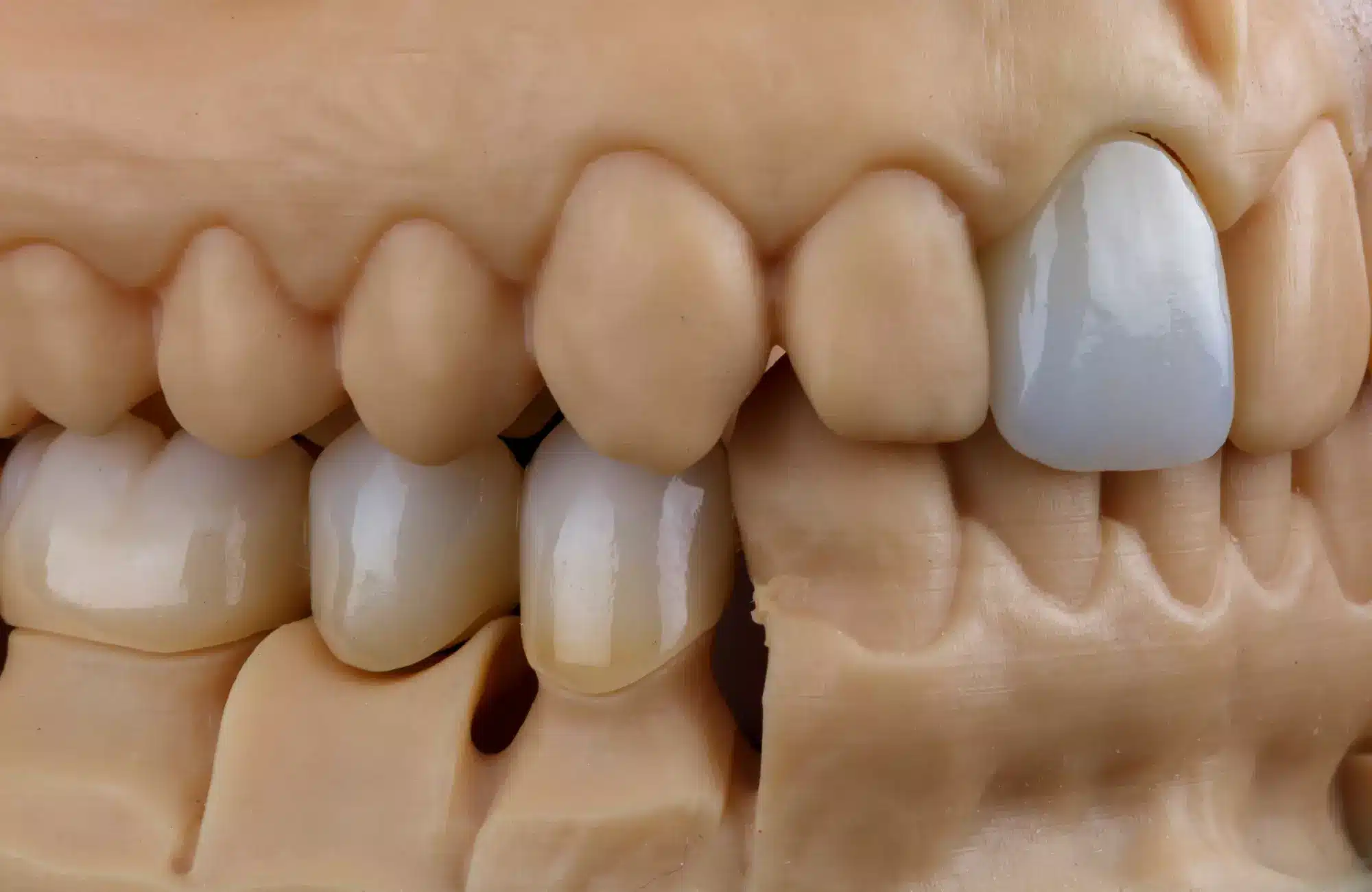 Dental crowns in Tijuana