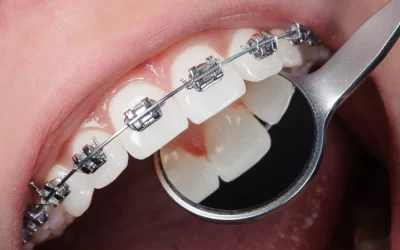 Why Braces in Tijuana are a Smart Investment for Your Smile