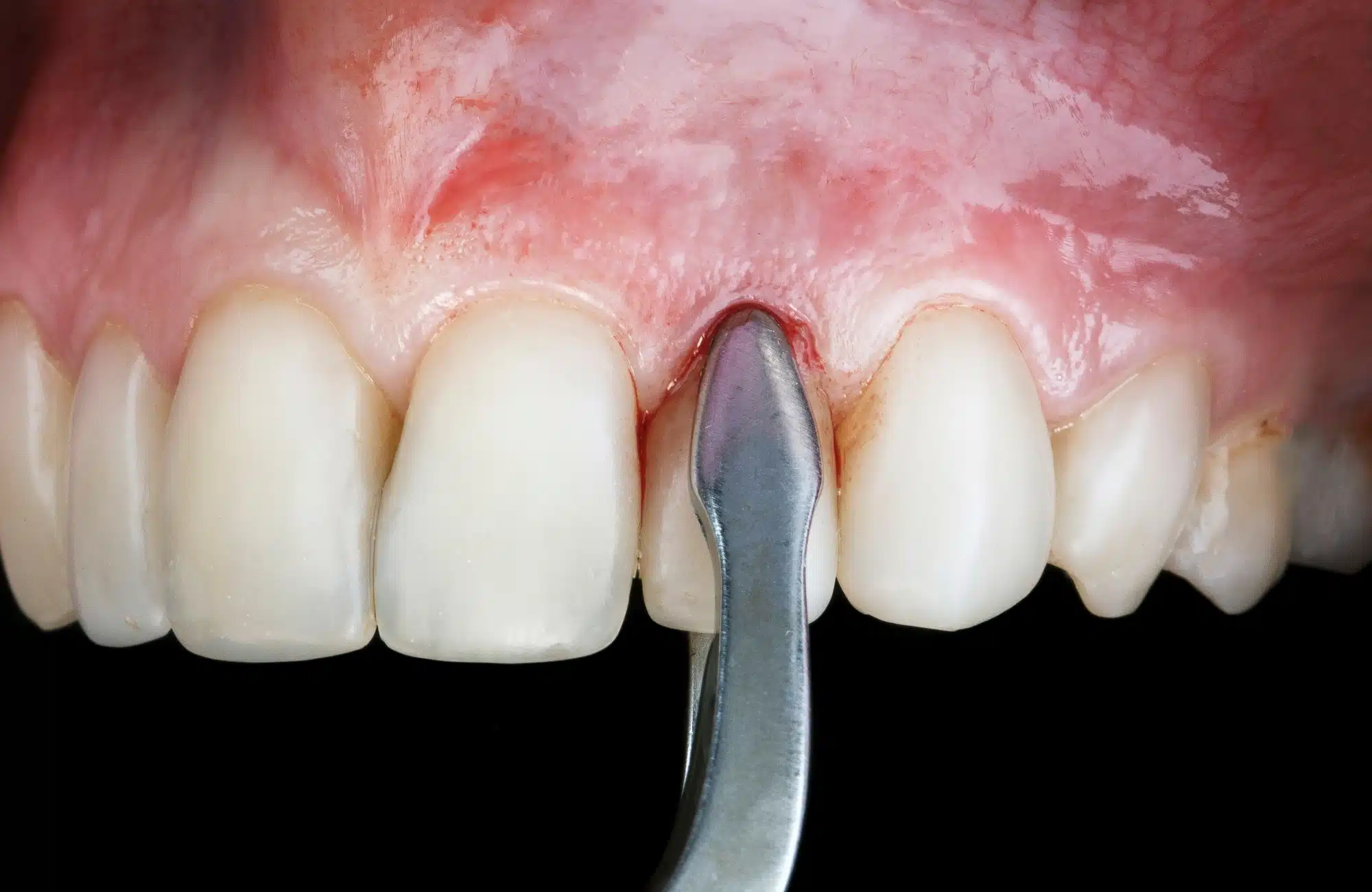 Oral Surgery