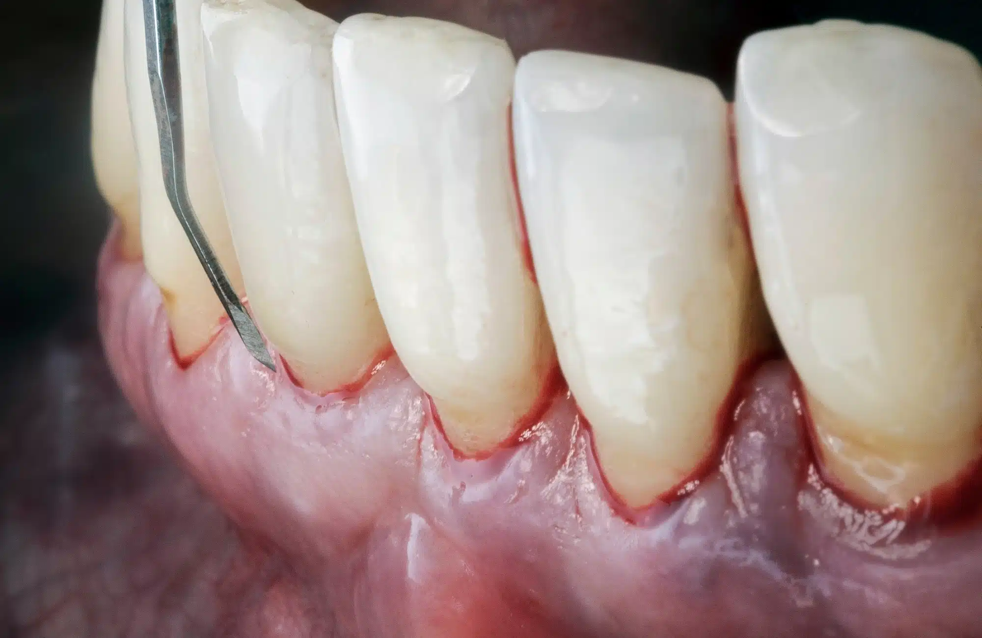 Periodontics in Tijuana