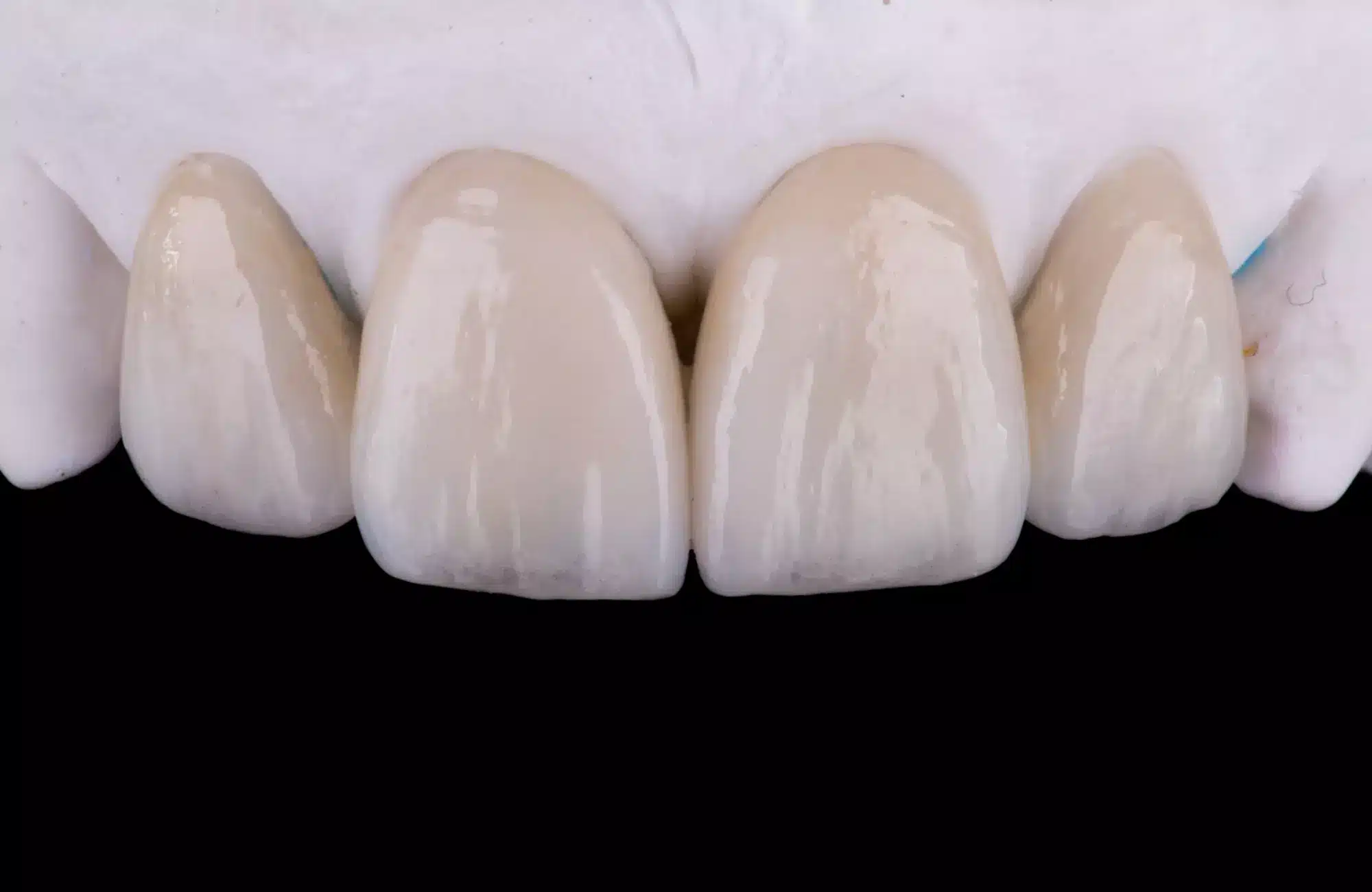 Dental veneers