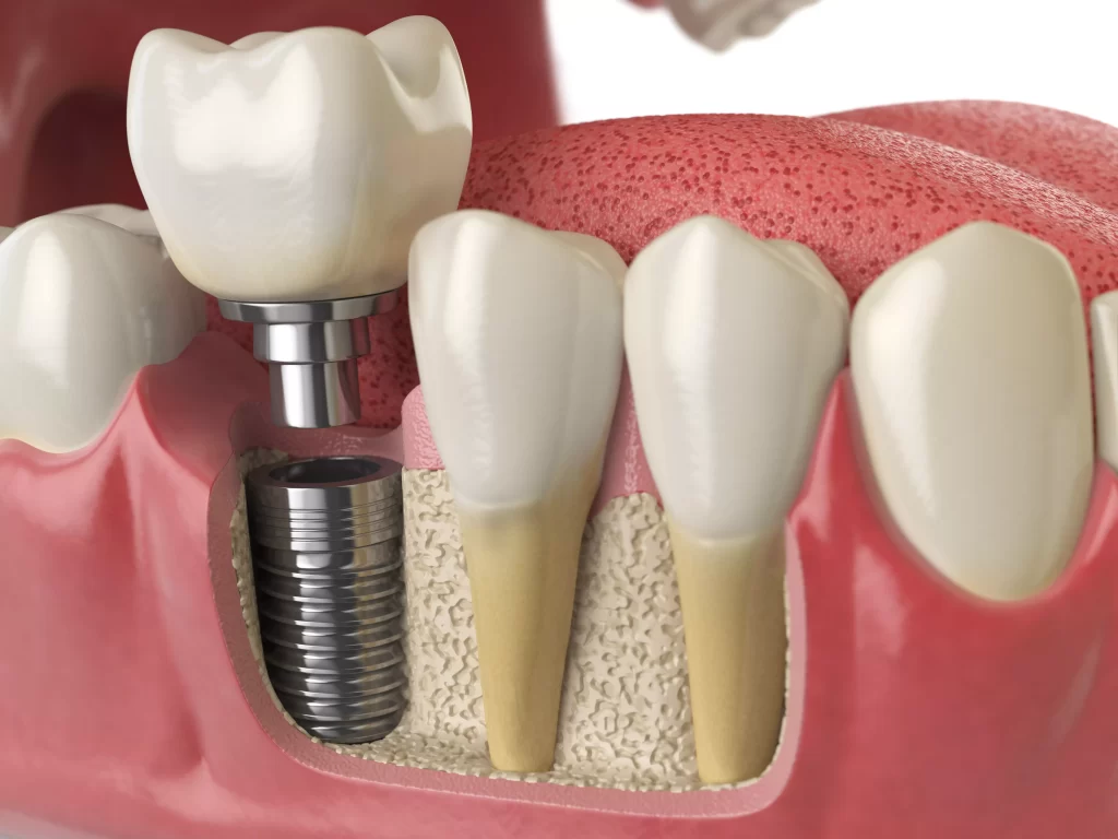 dental implants tijuana mexico