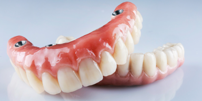 dental-implants-tijuana