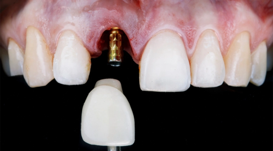 dental-implants-in-one-day