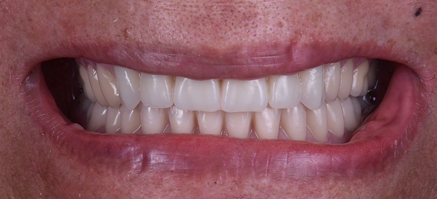Implantes-dentales-tijuana-foto-despues