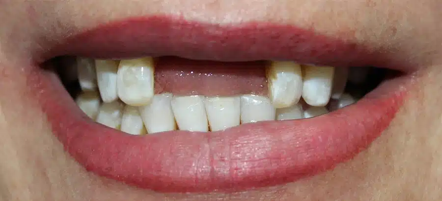 Poli Before Dental Implants