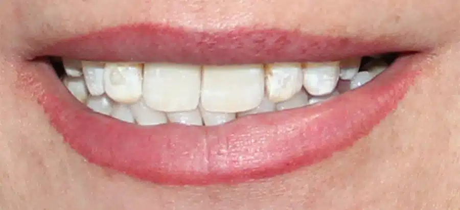 Poli After Dental Implants