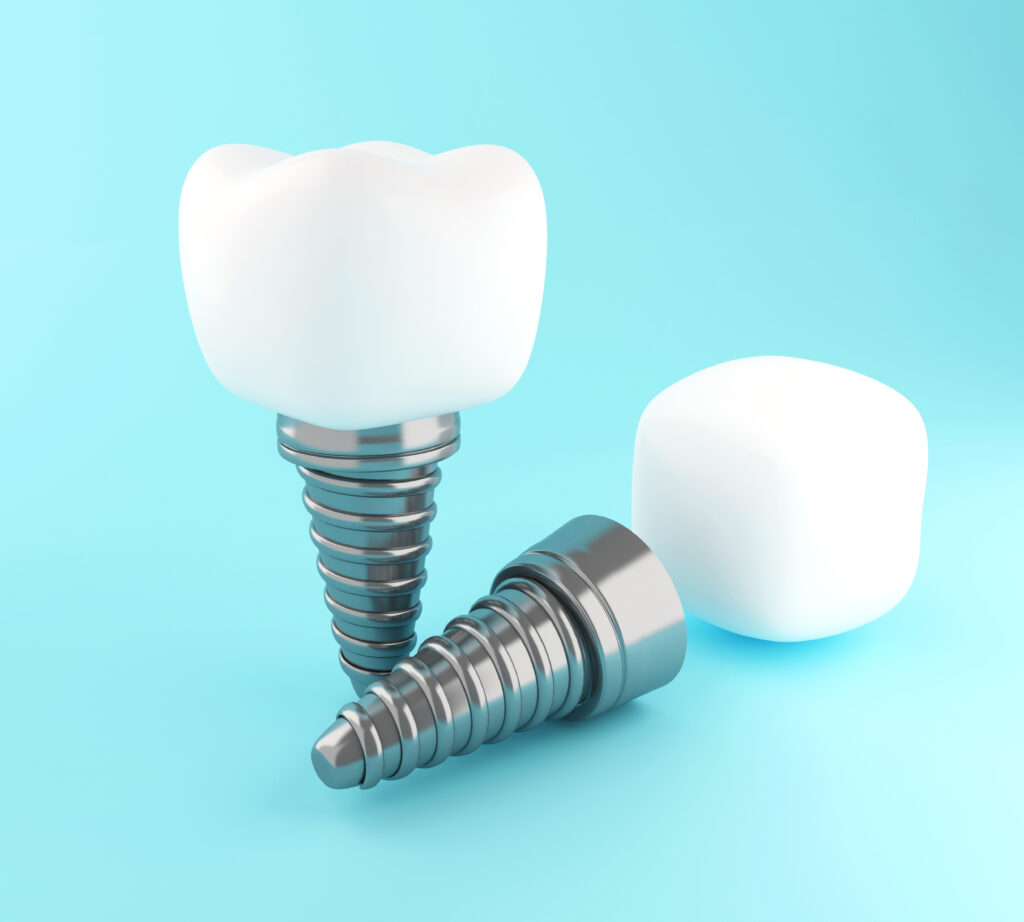 Dental Implants in Tijuana