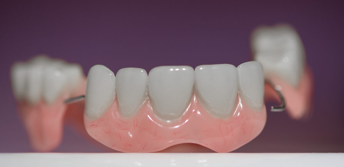 Dental implant - Dental Crown