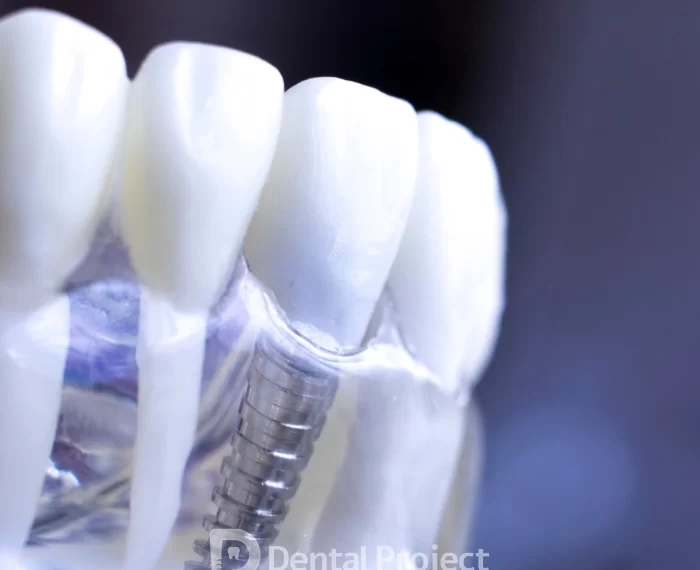 Implantes dentales en Tijuana