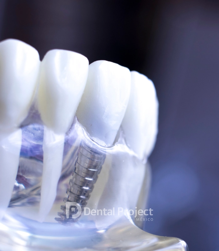 Dental Project Mexico 3D dental implant.