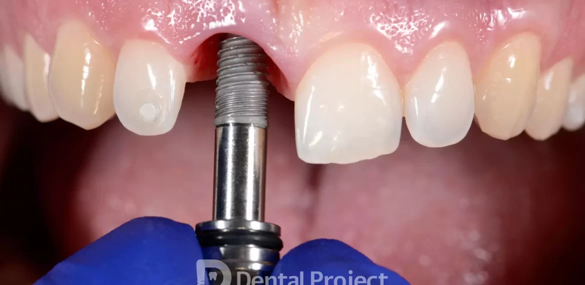 Implantes dentales en Tijuana