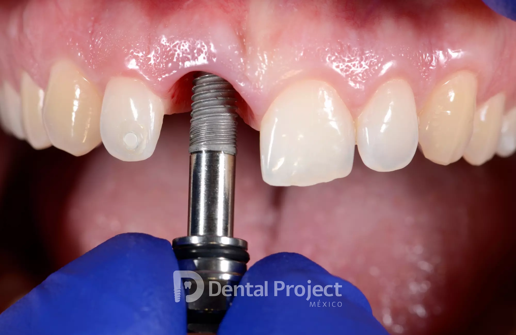 Dental Project Mexico dental implant 1.