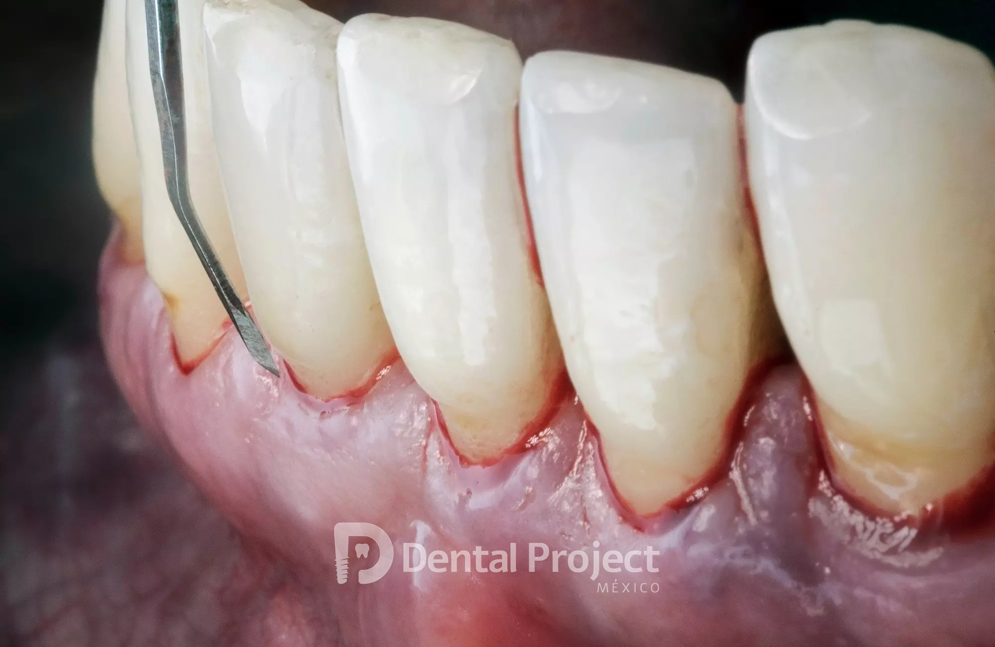 Dental Project Mexico Periodontics.