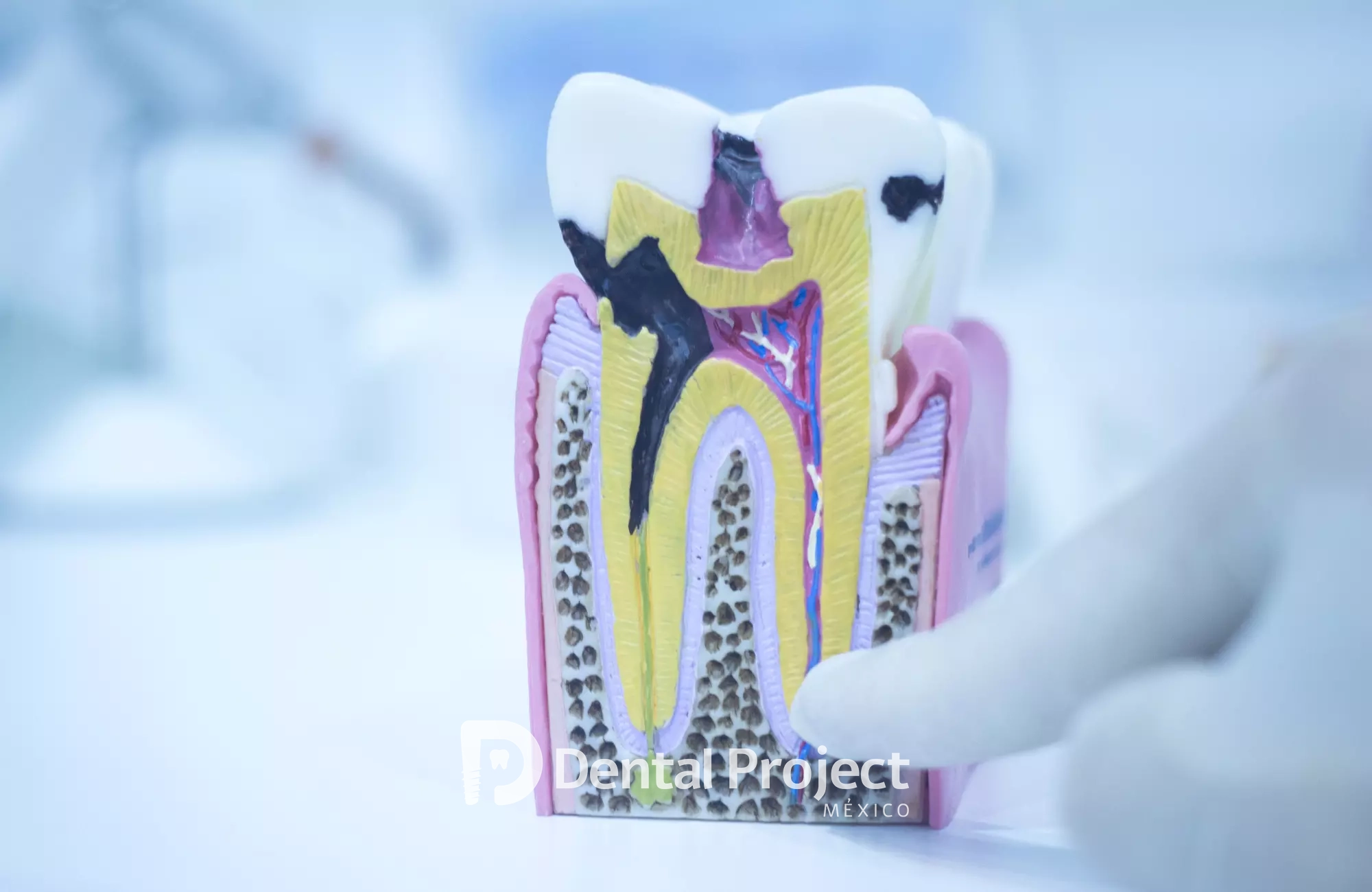 Dental Project Mexico Endodontics.